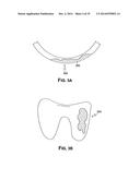 Methods of Predicting Musculoskeletal Disease diagram and image