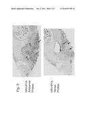 DIFFERENTIATION BETWEEN TRANSIENT AND PERSISTENT HIGH-RISK HPV INFECTION     BY IN SITU HYBRIDIZATION diagram and image