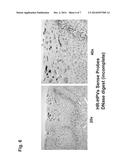 DIFFERENTIATION BETWEEN TRANSIENT AND PERSISTENT HIGH-RISK HPV INFECTION     BY IN SITU HYBRIDIZATION diagram and image