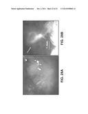 METHODS AND DEVICES FOR STIMULATING AN IMMUNE RESPONSE USING NANOSECOND     PULSED ELECTRIC FIELDS diagram and image