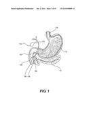 VACUUM-ASSISTED PANCREATICOBILIARY CANNULATION diagram and image