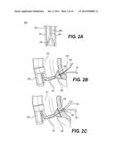 VACUUM-ASSISTED PANCREATICOBILIARY CANNULATION diagram and image