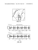 METHOD AND APPARATUS FOR USING PHONOMYOGRAPHY TO PREVENT NERVE DAMAGE     DURING A MEDICAL PROCEDURE diagram and image