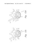 DEVICES AND METHODS FOR TREATING BONE TISSUE diagram and image