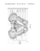 INTRAMEDULLARY FIXATION SYSTEM FOR MANAGEMENT OF PELVIC AND ACETABULAR     FRACTURES diagram and image