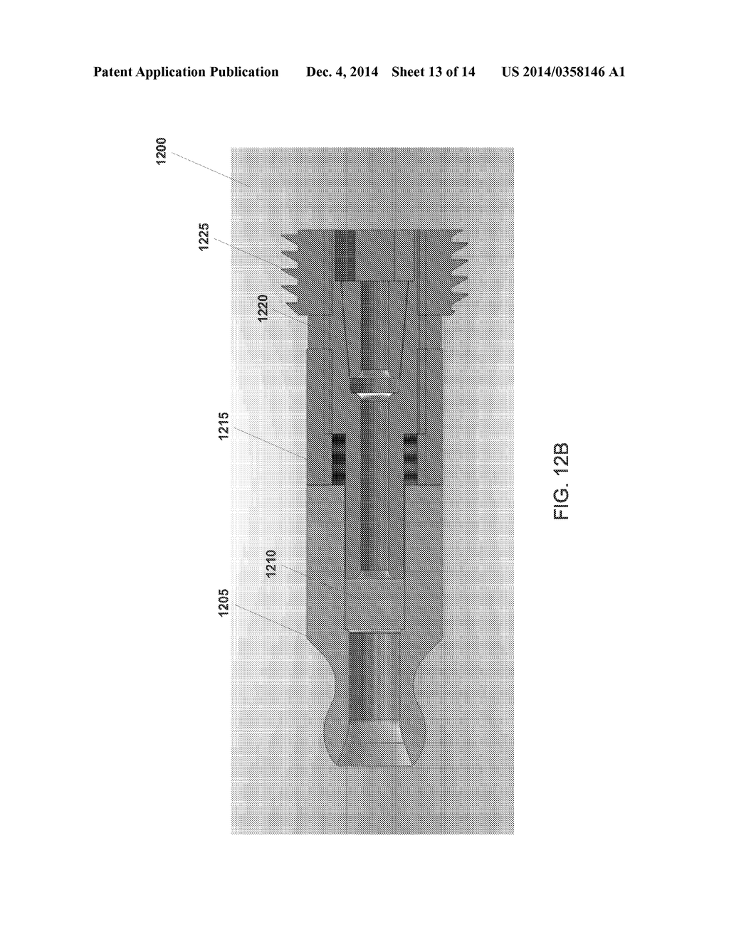 INTRAMEDULLARY FIXATION SYSTEM FOR MANAGEMENT OF PELVIC AND ACETABULAR     FRACTURES - diagram, schematic, and image 14