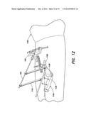 METHOD AND APPARATUS FOR PERFORMING ANTERIOR HIP SURGERY diagram and image