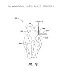 METHOD AND APPARATUS FOR PERFORMING ANTERIOR HIP SURGERY diagram and image