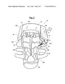 DRILLING MASK FOR IMPLANTING A TRANSPEDICULAR SCREW diagram and image