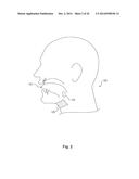 Implant Unit for Modulation of Small Diameter Nerves diagram and image