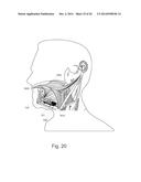 Implant Unit for Modulation of Small Diameter Nerves diagram and image