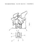 METHODS AND APPARATUS FOR AN OSTEOTOMY FIXATION OR ARTHRODESIS CAGE diagram and image