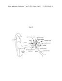 Controlled Release Corticosteroid Compositions and Methods for the     Treatment of Otic Disorders diagram and image