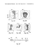 SYSTEMS AND METHODS FOR PERFORMING IMAGE GUIDED PROCEDURES WITHIN THE EAR,     NOSE, THROAT AND PARANASAL SINUSES diagram and image