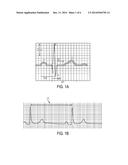 METHODS AND SYSTEMS FOR PREDICTING HYPOVOLEMIC HYPOTENSIVE CONDITIONS     RESULTING FROM BRADYCARDIA BEHAVIOR USING A PULSE VOLUME WAVEFORM diagram and image