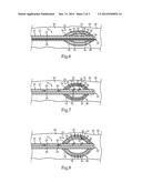 Weeping Balloon Catheter With Drug Delivery Through Dilation Balloon diagram and image