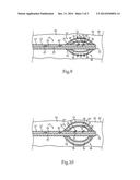 Weeping Balloon Catheter With Drug Delivery Through Dilation Balloon diagram and image