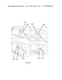 ENDOSCOPIC SNARE DEVICE diagram and image