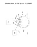 METHOD, APPARATUS, AND A SYSTEM FOR ROBOTIC ASSISTED CATARACT SURGERY diagram and image