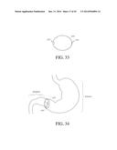 INTRAGASTRIC DEVICE diagram and image