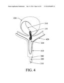 EXCLUSION DEVICE AND SYSTEM FOR DELIVERY diagram and image