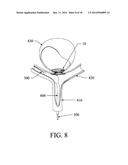 EXCLUSION DEVICE AND SYSTEM FOR DELIVERY diagram and image