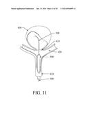 EXCLUSION DEVICE AND SYSTEM FOR DELIVERY diagram and image