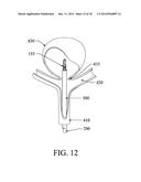 EXCLUSION DEVICE AND SYSTEM FOR DELIVERY diagram and image