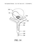 EXCLUSION DEVICE AND SYSTEM FOR DELIVERY diagram and image