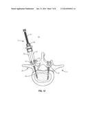 SPINAL CORRECTION SYSTEM diagram and image