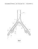 INTRODUCER FOR AN ILIAC SIDE BRANCH DEVICE diagram and image