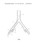 INTRODUCER FOR AN ILIAC SIDE BRANCH DEVICE diagram and image