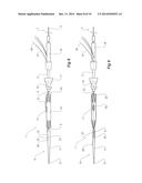 INTRODUCER FOR AN ILIAC SIDE BRANCH DEVICE diagram and image