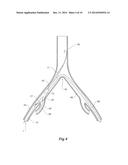 INTRODUCER FOR AN ILIAC SIDE BRANCH DEVICE diagram and image