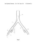 INTRODUCER FOR AN ILIAC SIDE BRANCH DEVICE diagram and image