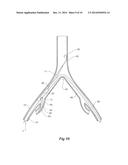 INTRODUCER FOR AN ILIAC SIDE BRANCH DEVICE diagram and image