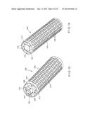 Graft Collection and Containment System for Bone Defects diagram and image