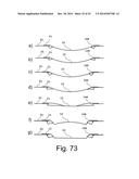 Beverage Can Having Deflecting Closure Element diagram and image