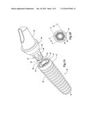 DENTAL IMPLANT SYSTEM diagram and image