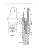 DENTAL IMPLANT SYSTEM diagram and image