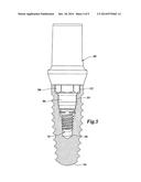 DENTAL IMPLANT SYSTEM diagram and image