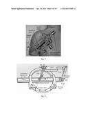 PATIENT MOUNTED MRI AND CT COMPATIBLE ROBOT FOR NEEDLE GUIDANCE IN     INTERVENTIONAL PROCEDURES diagram and image