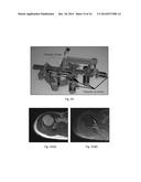 PATIENT MOUNTED MRI AND CT COMPATIBLE ROBOT FOR NEEDLE GUIDANCE IN     INTERVENTIONAL PROCEDURES diagram and image