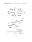 Stretch Valve Balloon Catheter and Methods for Producing and Using Same diagram and image