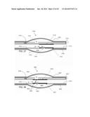 Stretch Valve Balloon Catheter and Methods for Producing and Using Same diagram and image