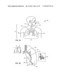 Minimally Invasive Lung Volume Reduction Devices, Methods, and Systems diagram and image