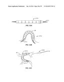 Minimally Invasive Lung Volume Reduction Devices, Methods, and Systems diagram and image