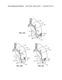 Minimally Invasive Lung Volume Reduction Devices, Methods, and Systems diagram and image