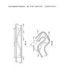 Minimally Invasive Lung Volume Reduction Devices, Methods, and Systems diagram and image