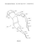 Minimally Invasive Lung Volume Reduction Devices, Methods, and Systems diagram and image